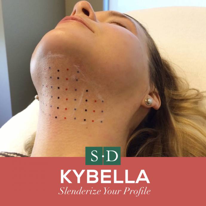 Kybella® in Birmingham, AL