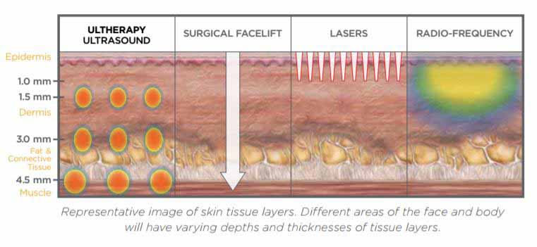 Ultherapy® in Birmingham, AL