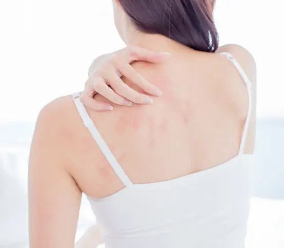 Eczema Treatment (Atopic Dermatitis) in Birmingham, AL