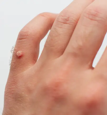 Wart Removal in Birmingham, AL