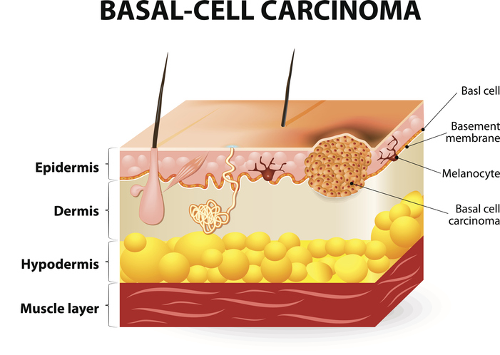 Basal Cell Carcinoma Treatment in Birmingham, AL