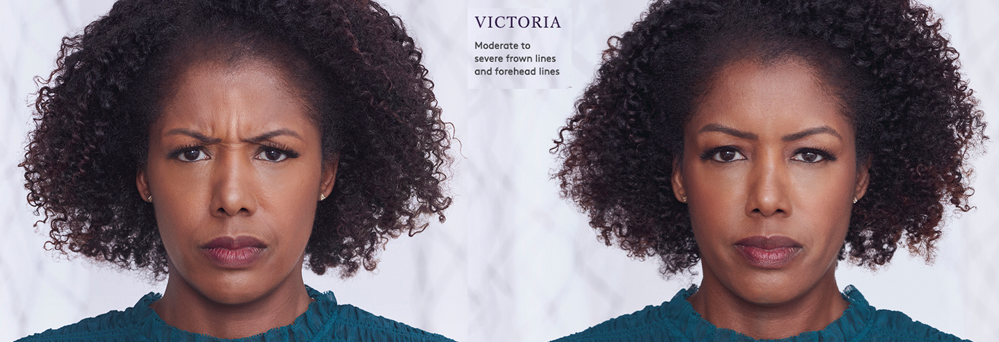 Botox2 Botox® in Birmingham, AL