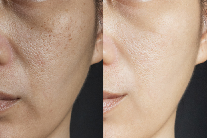 Melasma Treatment in Birmingham, AL