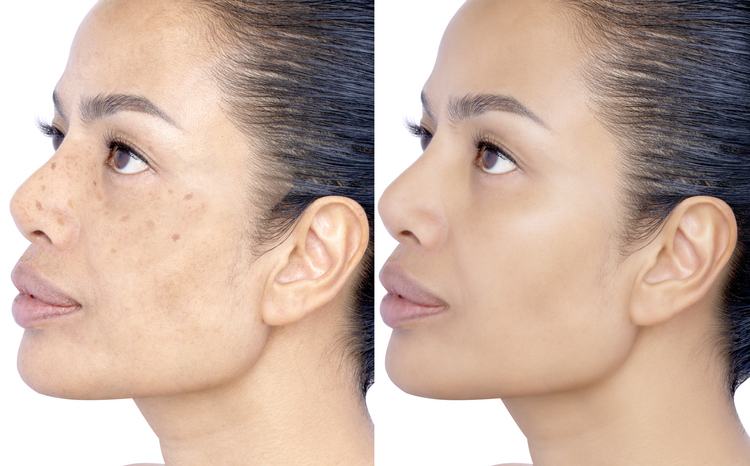 Melasma Treatment in Birmingham, AL