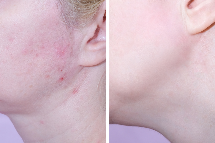 Acne Treatment in Birmingham, AL