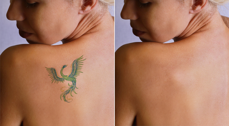 Laser tattoo removal befor and after. Laser Tattoo Removal in Birmingham, AL