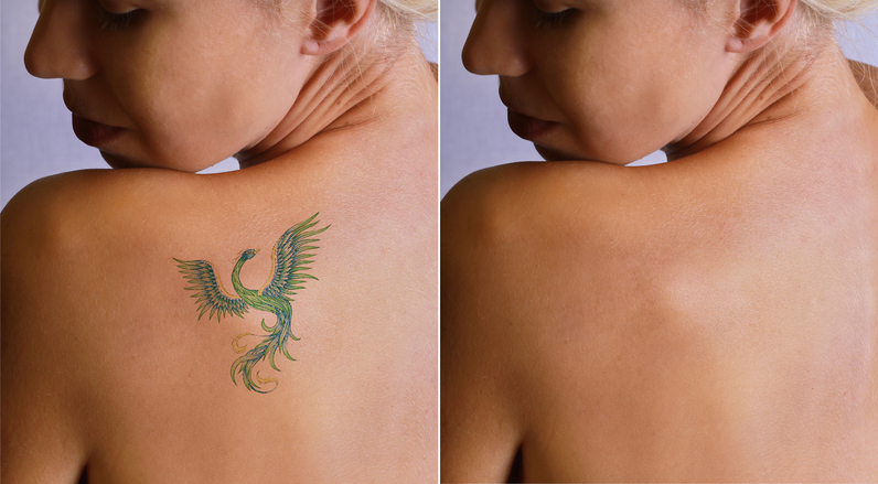 Laser Tattoo Removal in Birmingham, AL