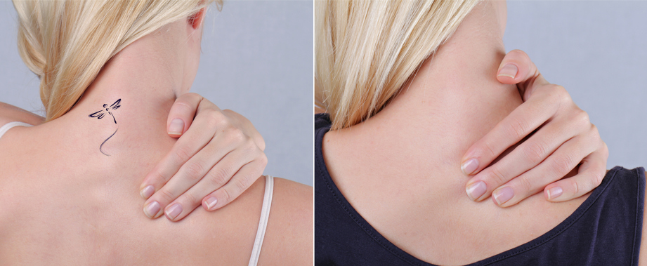 Laser tattoo removal before and after. Laser Tattoo Removal in Birmingham, AL
