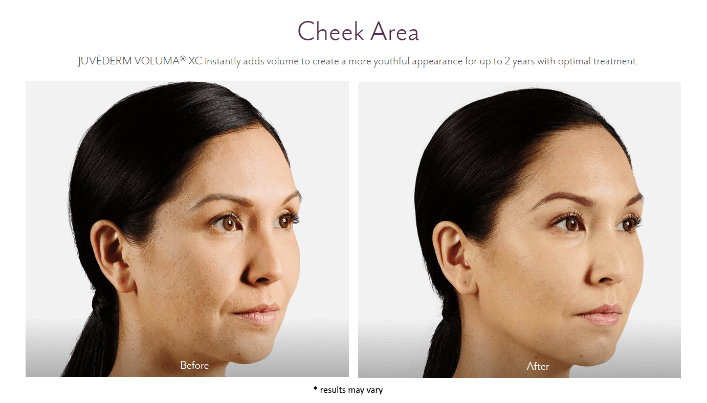 Juvederm1 Juvederm® in Birmingham, AL