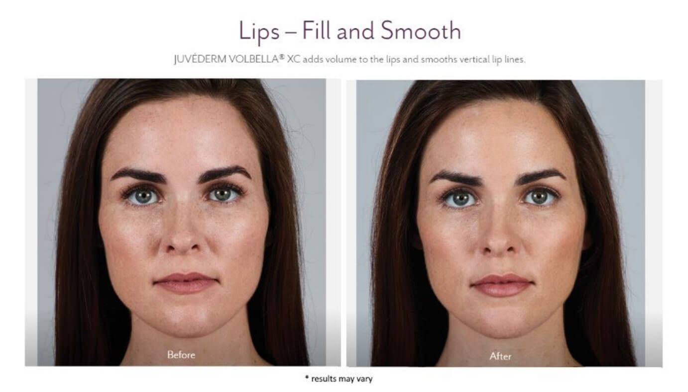 Juvederm2 Juvederm® in Birmingham, AL