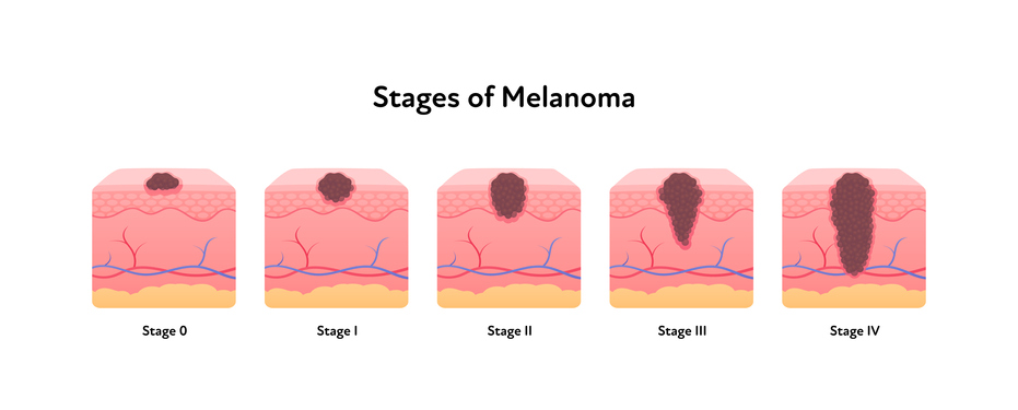 Melanoma cancer anatomical infographic poster. Vector flat medical illustration. Stages of tumor disease. Design for healthcare, oncology, dermatology. Melanoma in Birmingham, AL