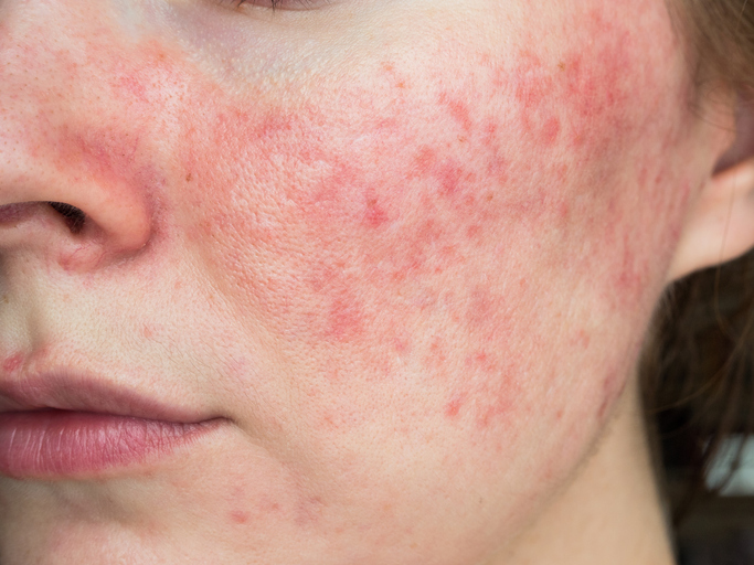 Rosacea Treatment in Birmingham, AL