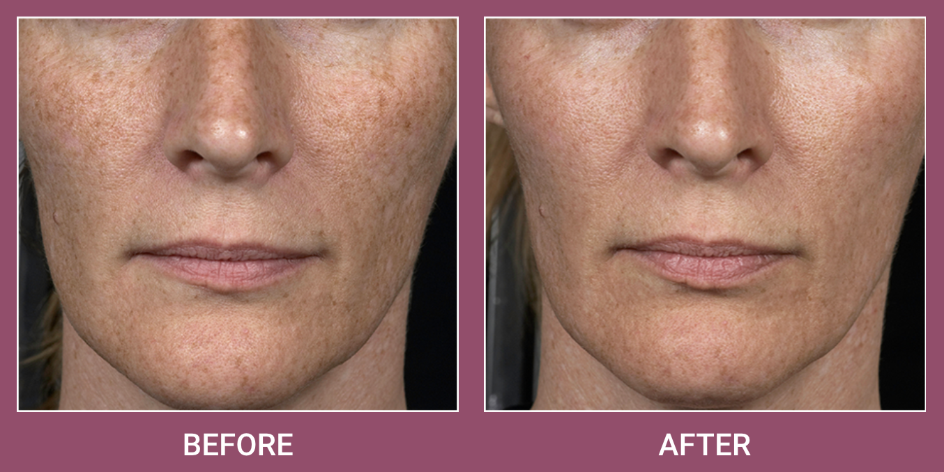 Screen Shot 2022-02-17 at 10.04.41 AM Fraxel Dual Laser Treatment in Birmingham, AL