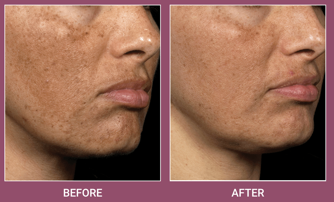 Screen Shot 2022-02-17 at 10.05.00 AM Fraxel Dual Laser Treatment in Birmingham, AL