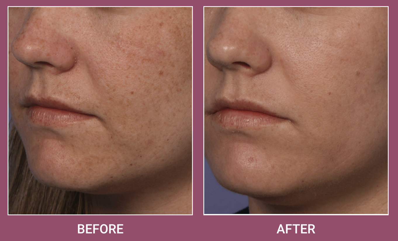 Screen Shot 2022-02-17 at 10.05.09 AM Fraxel Dual Laser Treatment in Birmingham, AL