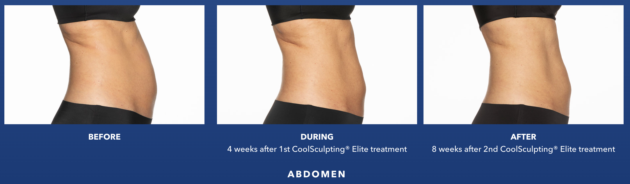 CoolSculpting® Elite in Birmingham, AL