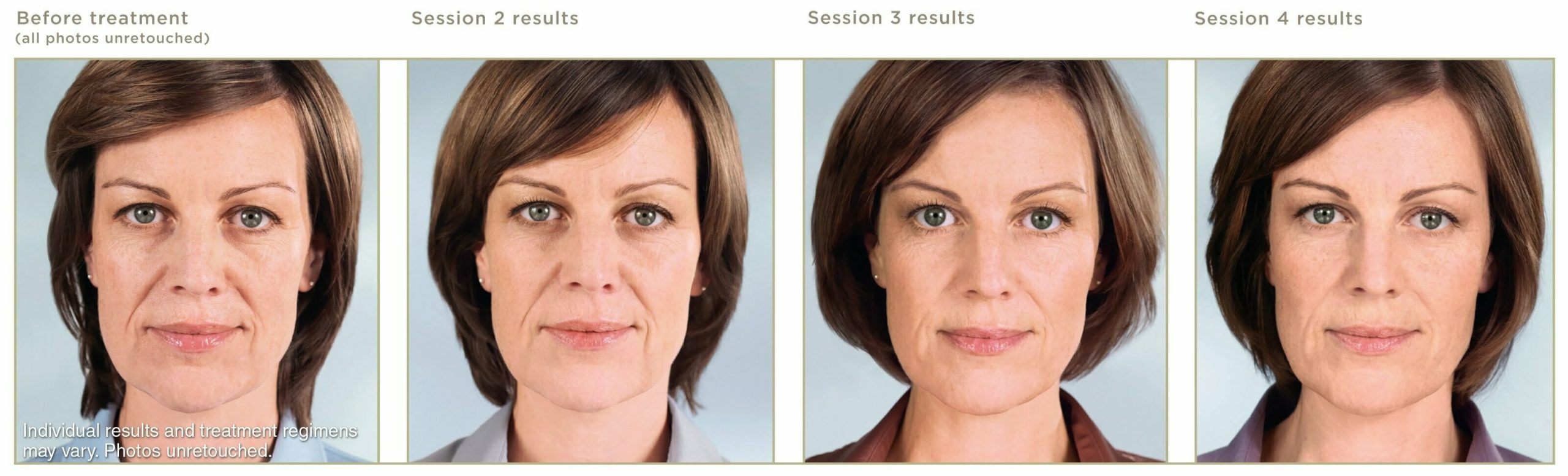 Sculptra® in Birmingham, AL