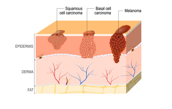 Squamous Cell Carcinoma Treatment in Birmingham, AL