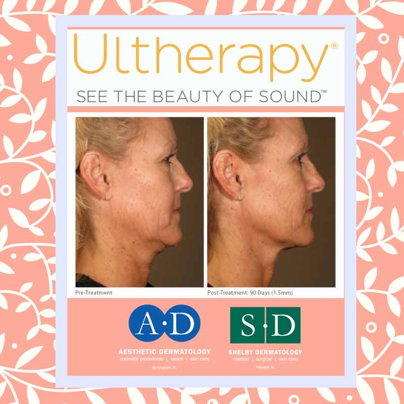 Ultherapy® in Birmingham, AL