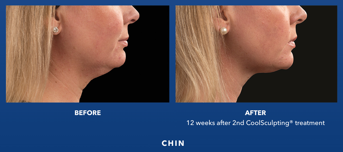 CoolSculpting® Elite in Birmingham, AL