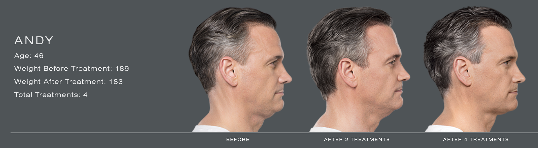 Kybella® in Birmingham, AL