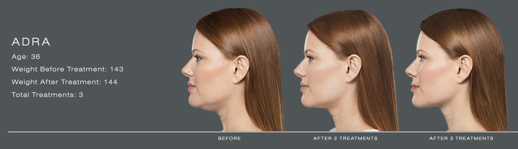 Kybella® in Birmingham, AL