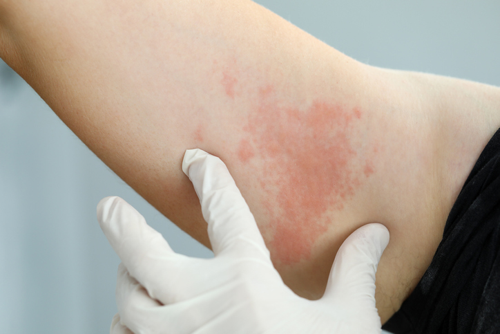 Rash Treatment in Birmingham, AL