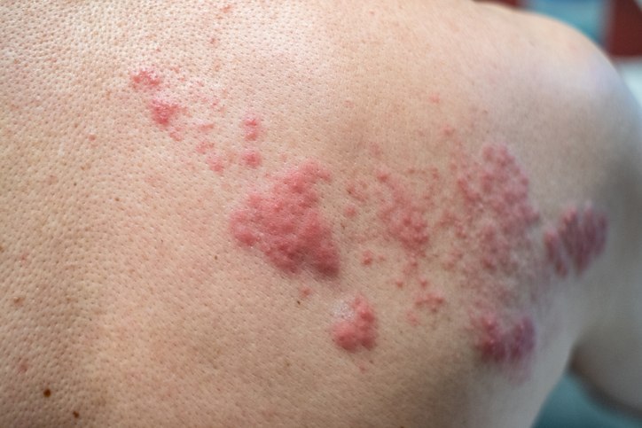 Shingles Treatment in Birmingham, AL