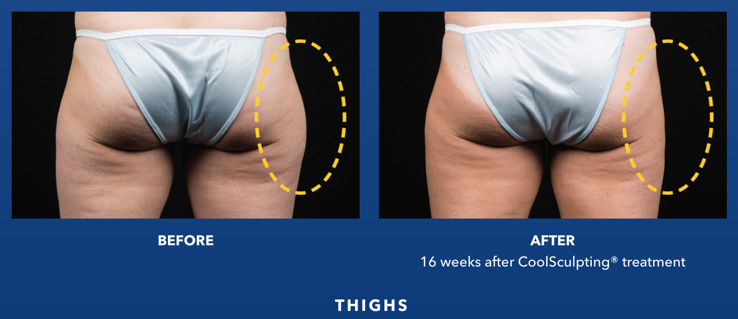 CoolSculpting® Elite in Birmingham, AL